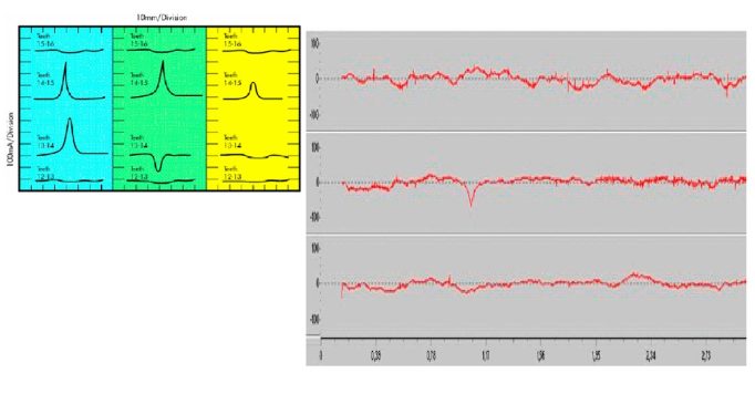 Electromagnetic core imperfection detection (El CID)